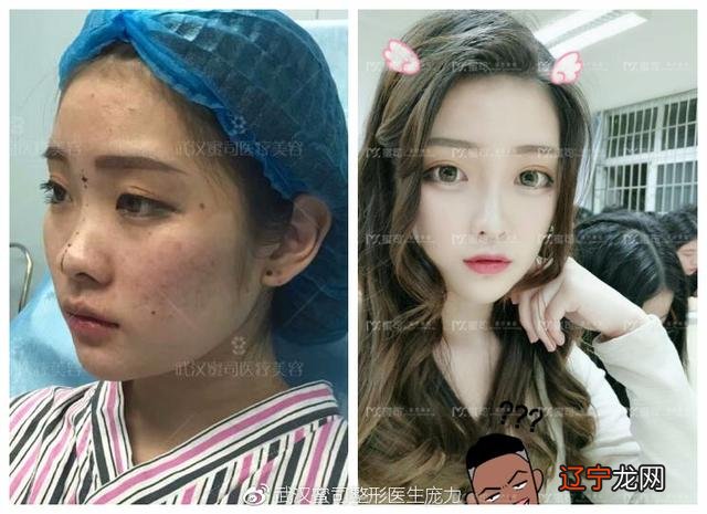 鼻梁纹怎么去除