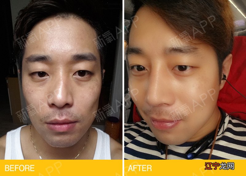 最全鼻子整形案例 明星变美都动过鼻子！