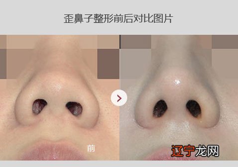 7种鼻型分类图:鼻子整形图片前后对比