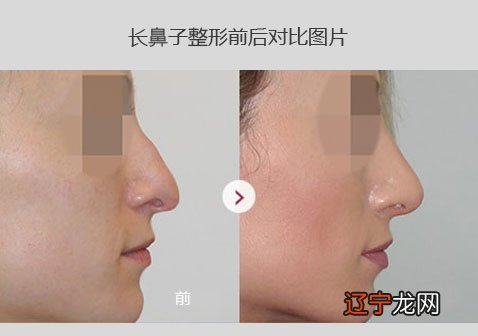 7种鼻型分类图:鼻子整形图片前后对比
