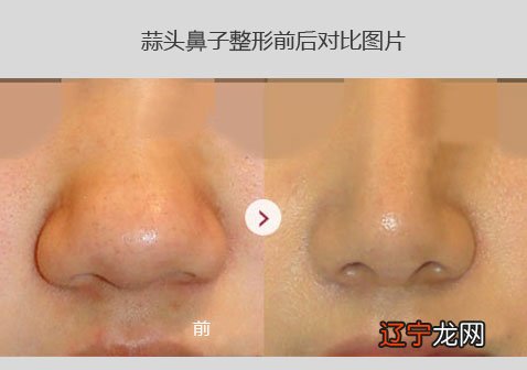 7种鼻型分类图:鼻子整形图片前后对比