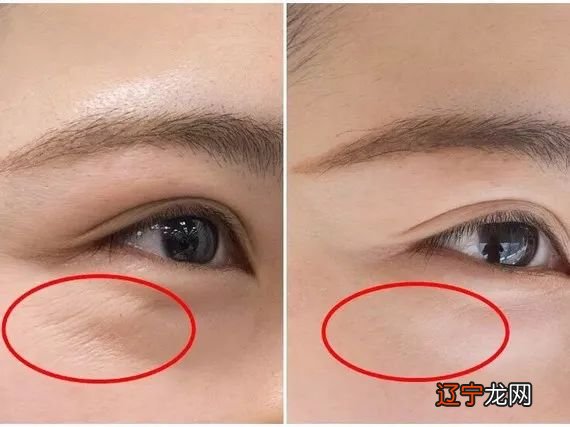 去鱼尾纹的最好土方法 鱼尾纹除皱方法