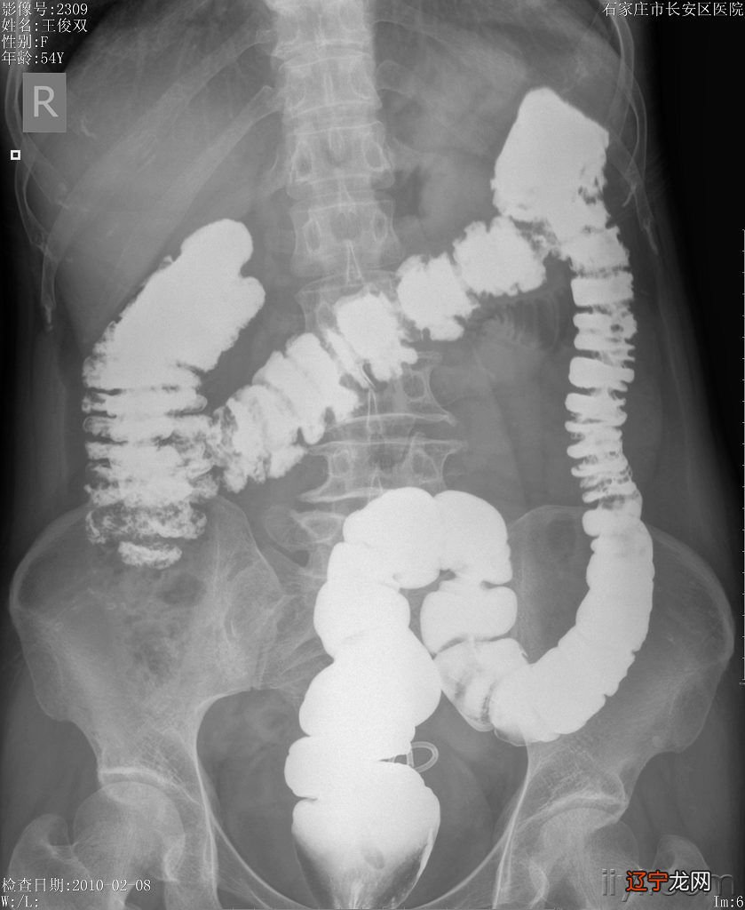 梦见自己便秘拉屎困难 女人梦见自己的拉大便