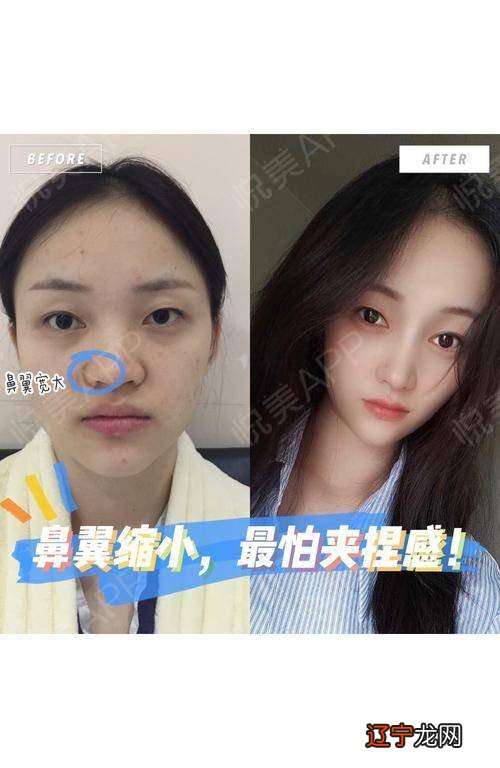 我是如何改善鼻翼肥大的