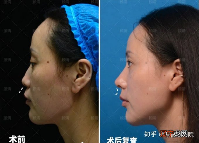 男人鼻头塌陷面相有什么说法?男人鼻梁低面相里好吗