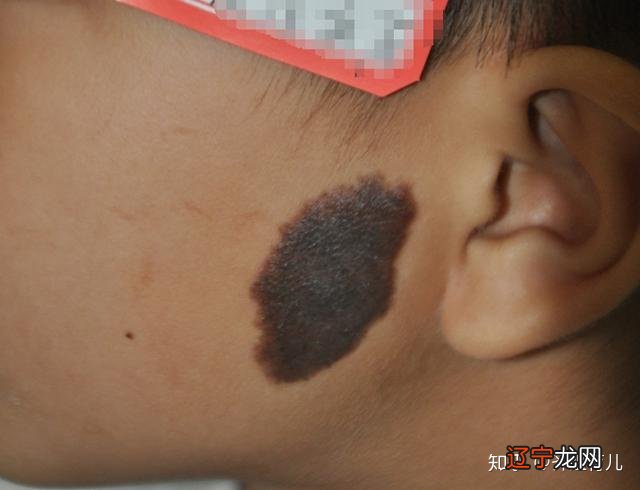 关于身上的胎记有一个美丽的传说