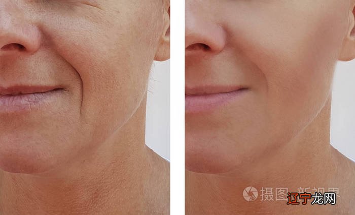 如何消除额头皱纹:怎么有效的去掉额头上的皱纹?