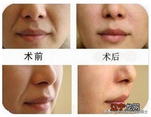 法令纹“分类”解决才有用,听医生给你支几招