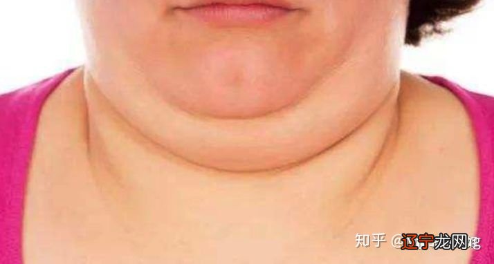 脖子粗怎么办?怎么减?