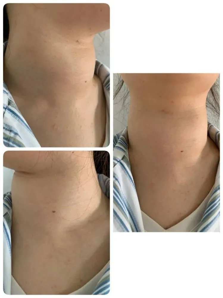 脖子粗怎么办?怎么减?