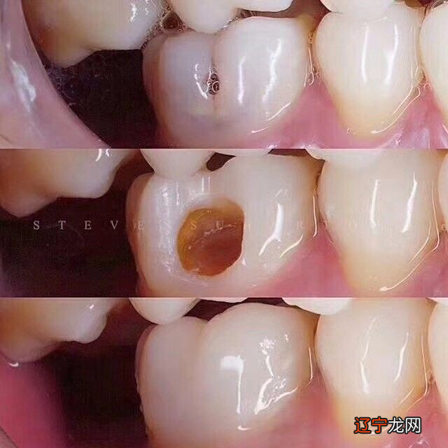 梦见自己牙齿掉了_梦见掉牙齿是什么征兆_梦见牙齿掉光又长出新牙齿