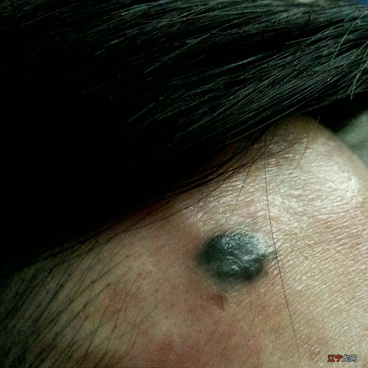 黑痣怎么去除_黑痣_黑痣