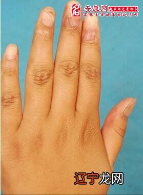 梦见手指头骨折 好不好风水堂:什么意思?好不好,代表着什么?