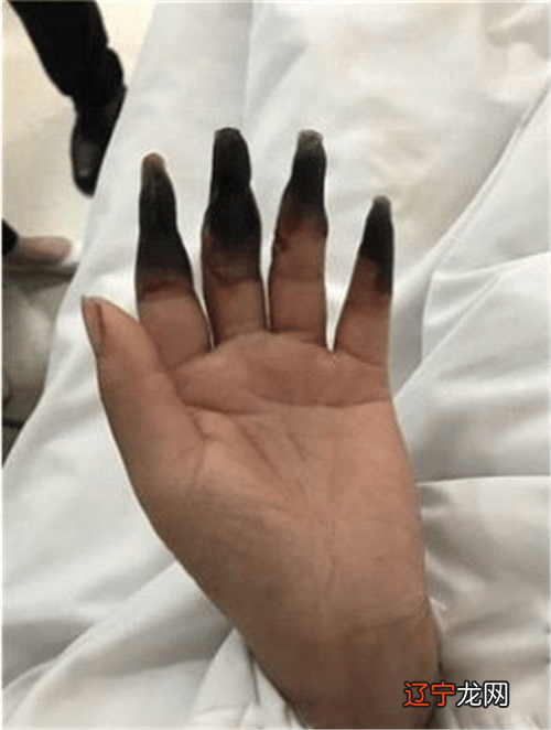 梦见手指头骨折 好不好风水堂:什么意思?好不好,代表着什么?