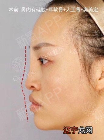 【李向东】山根断的人六亲无靠,你知道吗?