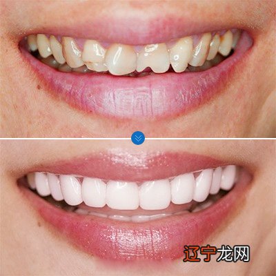 树脂补牙容易掉吗_门牙补牙是不是容易掉_见补牙掉了