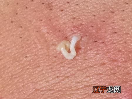 梦见把虫子从皮肤里挤出来