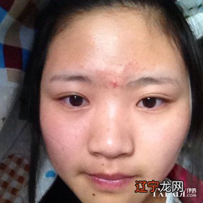 脸上长小红痘痘,痘痘上有小白点,还十分的痒_眉毛上长痘痘面相学是什么意思_面相男左眉长了一根长眉毛