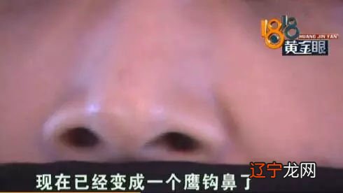 一个女士整形整成了“鹰钩鼻”向医院索赔240万