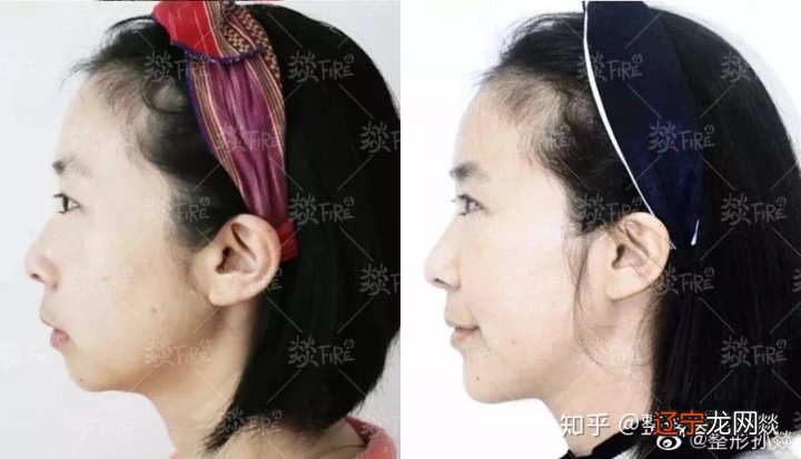 “美人在骨不在皮还是在骨”的原因