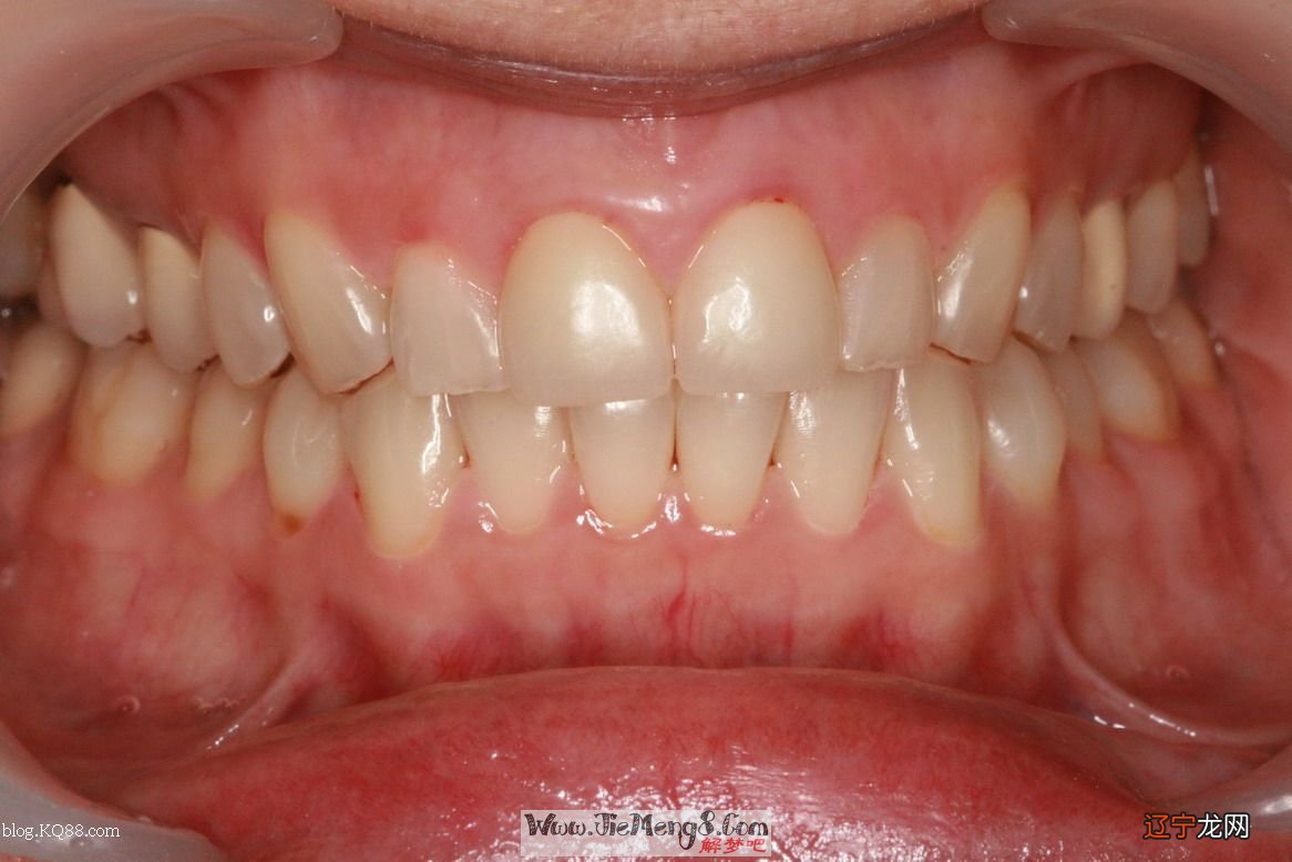 风水堂:梦见牙齿掉了一颗牙