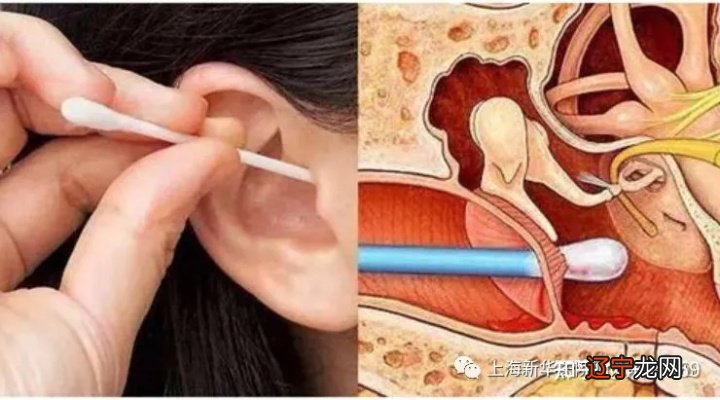 耳朵痒的常见原因有哪些？耳朵进水怎么办？